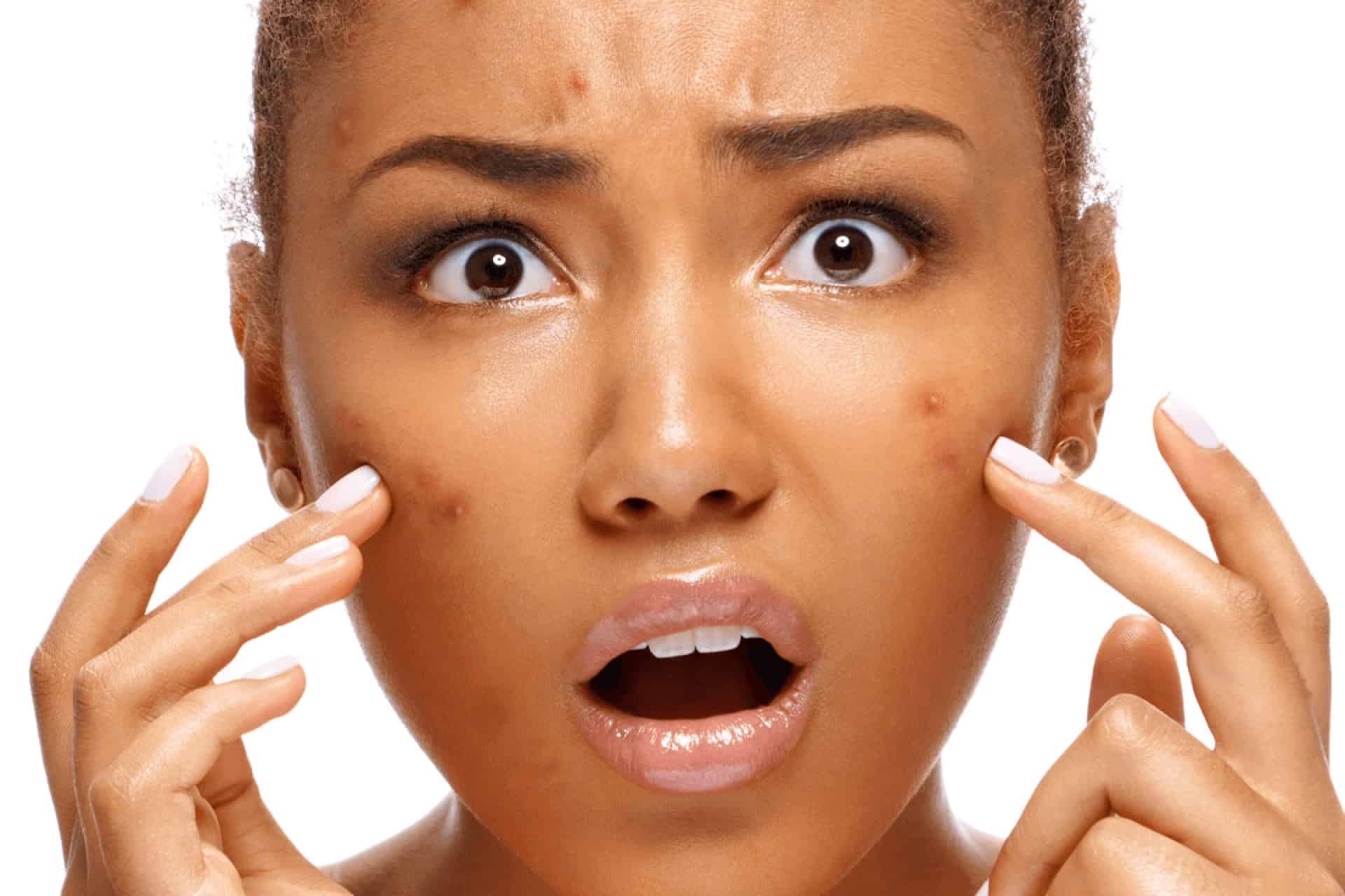 Acne: Types and Treatments