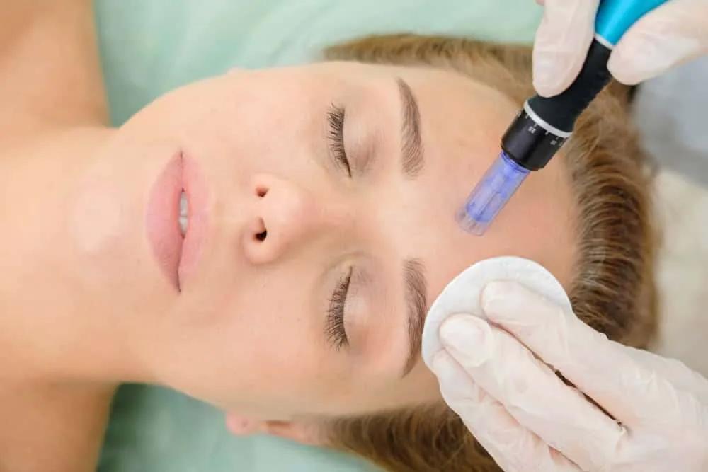Microneedling, Is It For Me?